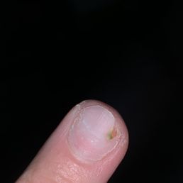 Natural nail after removing acrylics where brown spot was seen