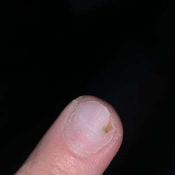 Nails By Yen - Natural nail after removing acrylics where brown spot was seen - Nail Salons Near Me - Tucson, Arizona