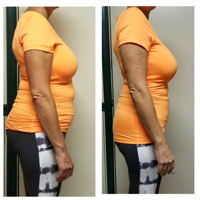 CryoSlimming - Several examples of the power of CryoSlimming which uses cryolipolysis (cold) to kill fat cells. The fat cells literally die and are processed out of your body. The procedure is absolutely painless and only takes around 30 minutes per session. There is no downtime! It costs half as much as CoolSculpting and the results are immediate. CryoSlimming - Several examples of the power of CryoSlimming which uses cryolipolysis (cold) to kill fat cells. The fat cells literally die and are processed out of your body. The procedure is absolutely painless and only takes around 30 minutes per session. There is no downtime! It costs half as much as CoolSculpting and the results are immediate.