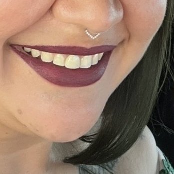 Newport Dental - After the front tooth implant - General Dentistry Near Me - Orange, California Newport Dental - After the front tooth implant - General Dentistry Near Me - Orange, California