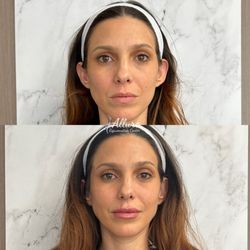 Allure Rejuvenation Center - Lip filler- beautiful, natural results.