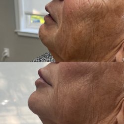 Beyond Beauty Med Spa - A lip and chin augmentation with Restylane products