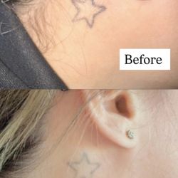 Un-Ink'd by Marisabel - Laser Tattoo Removal