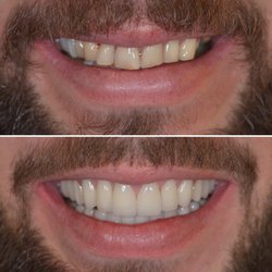 Dr. Cem Baysal - Implants and zirconium crowns