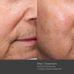 Arlington Integrative Medical Center - Our needle -free laser resurfacing improves the appearance of fine lines , skin texture and tone without any downtime