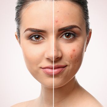Timeless Beauty Secrets - Acne Corrective Facial - Permanent Makeup Near Me - Vienna, Virginia Timeless Beauty Secrets - Acne Corrective Facial - Permanent Makeup Near Me - Vienna, Virginia