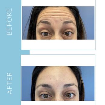 Gravity MedSpa - Botox 2 weeks before and after - Medical Spas Near Me - San Juan Capistrano, California