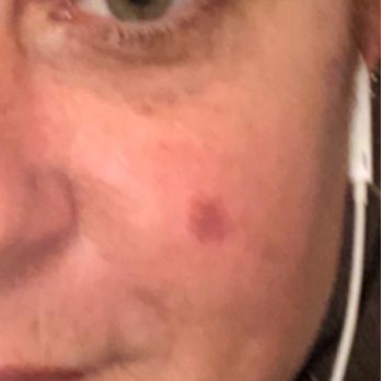 Medspa Deluxe LA - Sunspot/age spot I've had for 6 years before my  1-laser treatment at Med Spa Deluxe LA. - Medical Spas Near Me - West Covina, California
