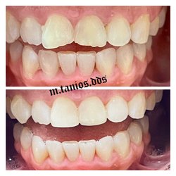 OC Splendid Smiles - Composite (white bonded) restorations to restore the 2 front chipped teeth. 949-855-3368 ocsplendidsmiles.com