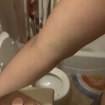 UCLA Health Burbank Laboratory - Bruising on top and under my elbow 6 days after blood draw. - Laboratory Testing Near Me - Burbank, California UCLA Health Burbank Laboratory - Bruising on top and under my elbow 6 days after blood draw. - Laboratory Testing Near Me - Burbank, California