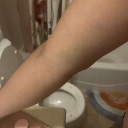 UCLA Health Burbank Laboratory - Bruising on top and under my elbow 6 days after blood draw.