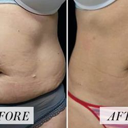 Skin Sanctuary Medspa - Another EmSculpt!