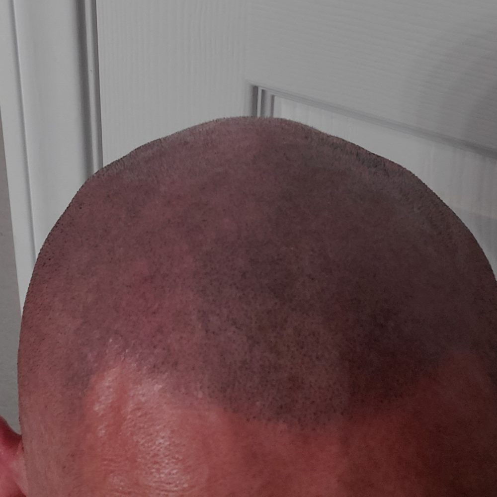 SMP INK - After - Hair Loss Centers Near Me - Las Vegas, Nevada SMP INK - After - Hair Loss Centers Near Me - Las Vegas, Nevada