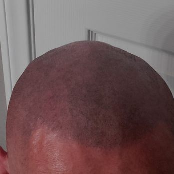 SMP INK - After - Hair Loss Centers Near Me - Las Vegas, Nevada