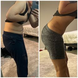 Advanced Institute for Plastic Surgery - Before and 10 weeks post op.