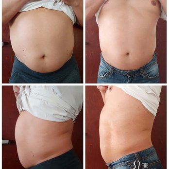 The Shape Shack - 2 full treatments (90 min) and 4 mini liposculpt sessions (20 min) - Body Contouring Near Me - Glendale, Arizona The Shape Shack - 2 full treatments (90 min) and 4 mini liposculpt sessions (20 min) - Body Contouring Near Me - Glendale, Arizona
