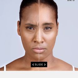 Elevated Direct Primary Care - Xeomin/Botox before and after
