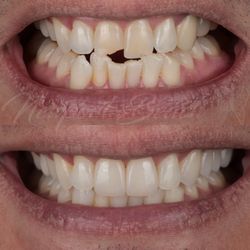 Newport Beach Dental Studio - Two Veneers