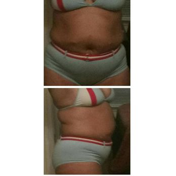 Total Body Solutions - 30 days still no results.... these are true pictures - Cosmetic Surgeons Near Me - Columbia, South Carolina