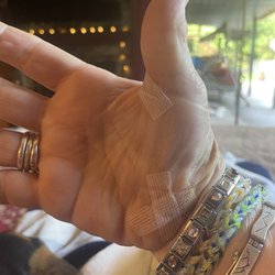 Sports Medicine Oregon - Right hand after stitch removal with Steri strips