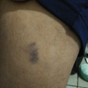 Coco Beach - These are the picture of my husband  he got beaten up while being unconscious after drinking 2 drinks from Coco Beach - Dance Clubs Near Me