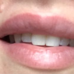 Bloom Facial Plastic Surgery - Another view of the lumps and blanching (Tyndall effect) 2 weeks post-op.
