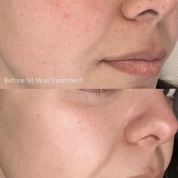 AOB Med Spa - Moxi Laser Treatment results before and after 3rd treatment.