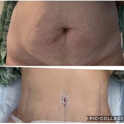 Pham Institute of Esthetic - Tummy tuck!