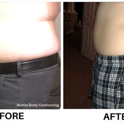 Austin Body Contouring - Austin Body Contouring Client Before & After