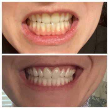 The Jaw Dropper - Before and after 1 session - Teeth Whitening Near Me The Jaw Dropper - Before and after 1 session - Teeth Whitening Near Me