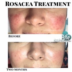 Augusta Sweet Sacred Skincareapy - There are over 16 million Americans with rosacea. I'm here to help!