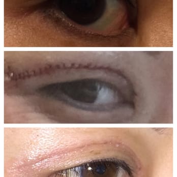 Joon Y Choi, MD - Original eye, right after surgery, 5 days after with stitches out - Medical Spas Near Me - Orange, California Joon Y Choi, MD - Original eye, right after surgery, 5 days after with stitches out - Medical Spas Near Me - Orange, California