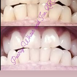 Pearly Whites and Ice - Before and after Laser Teeth Whitening