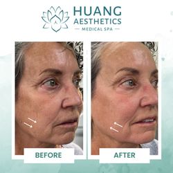 JadeWaves Medspa - Skin tightening treatment is an option for patients seeking facial rejuvenation.