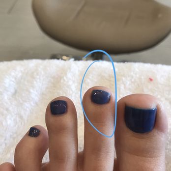 Diamond Nail Spa - Crooked toenails from a rushed 20 minute pedicure by Lin. - Waxing Near Me - Modesto, California Diamond Nail Spa - Crooked toenails from a rushed 20 minute pedicure by Lin. - Waxing Near Me - Modesto, California