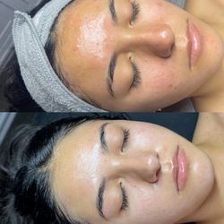 Awaken Aesthetics - Acne Bootcamp before and after