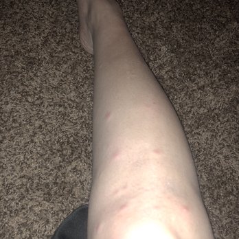 The Voss - Bed bug bites - Apartments Near Me - Houston, Texas
