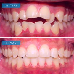 Holliday Orthodontics - Before and after on our patient.