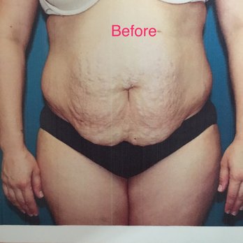 Precision Plastic Surgery - Before my mommy make over (tummy tuck, liposuction, breast augmentation/ replacement and lift) - Cosmetic Surgeons Near Me - Rancho Cucamonga, California