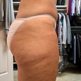 Suddenly Slimmer - 12/18 client after one full body supreme wrap. noticeable smoothing and cellulite reduction! - Weight Loss Centers Near Me - Roswell, Georgia