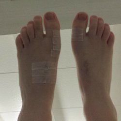Brayton Campbell, DPM - Post-surgery: Left Lapidus Bunionectomy and Bilateral Akin Osteotomies