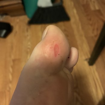 Hilton Nails and Spa - This is my toe that I left a chunk of at Hilton's. - Nail Salons Near Me - Laurel, Maryland