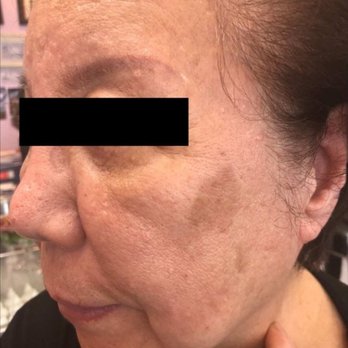 Division Day Spa - REMOVAL Senile Plaques 2 Times - Day Spas Near Me - New York, New York Division Day Spa - REMOVAL Senile Plaques 2 Times - Day Spas Near Me - New York, New York