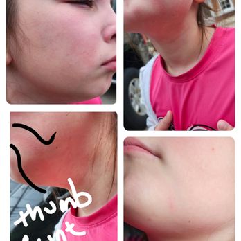 Hanover Pediatric Dentistry - my daughters face-top right obviously crying upset, top left full handprint from her mouth down onto her throat, bottom right scratch left - Pediatric Dentists Near Me - Hanover, Pennsylvania