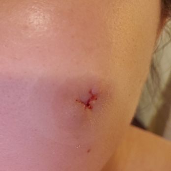 PSY Spa USA - Do not come here for facial! Result after surgery for cyst removal. - Skin Care Near Me - San Leandro, California PSY Spa USA - Do not come here for facial! Result after surgery for cyst removal. - Skin Care Near Me - San Leandro, California