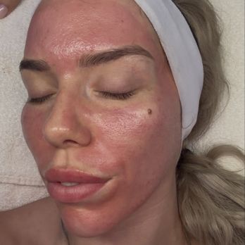 Laser & More - Micro-needling immediate results - Laser Hair Removal Near Me - Sunny Isles Beach, Florida Laser & More - Micro-needling immediate results - Laser Hair Removal Near Me - Sunny Isles Beach, Florida