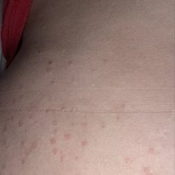AmeriVu Inn - Bacterial folliculitis as a result of stay at this hell hole did I mention they threatened to call the cops on us?