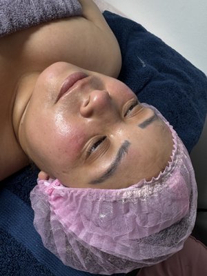 ✨ Microneedling Services  ✨ - About Me
Hi, I’m Cinthia, a licensed skin care professional with [X] years of experience in the aesthetics industry. I am certified in microneedling and continuously stay up-to-date with the latest techniques and safety protocols to ensure the best results for my clients. My mission is to help you feel confident and beautiful in your own skin.

What is Microneedling?
Microneedling, also known as collagen induction therapy, is a minimally invasive treatment that uses fine needles to create tiny punctures in the skin. This process stimulates your body’s natural healing response, boosting collagen and elastin production for healthier, younger-looking skin.

Benefits of Microneedling
✅ Reduces fine lines and wrinkles
✅ Improves skin texture and tone
✅ Minimizes acne scars and stretch marks
✅ Shrinks enlarged pores
✅ Enhances product absorption
✅ Promotes collagen and elastin production
✅ Safe for all skin types with minimal downtime

Why Choose Me?
🌟 Licensed Professional – Fully certified and trained in microneedling and skin health.
🌟 Customized Treatments – Each session is tailored to your unique skin needs and goals.
🌟 Clean & Safe Environment – I follow strict hygiene and safety protocols for your peace of mind.
🌟 Passionate About Results – I genuinely care about your skin journey and am here to support you every step of the way.