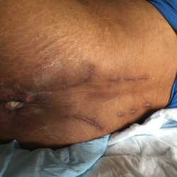 Care One @ Evesham - Bedsore and surgical scars from infections while at Care One Marlton