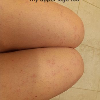 SEV Laser - Laser Hair Removal Near Me - Burlingame, California